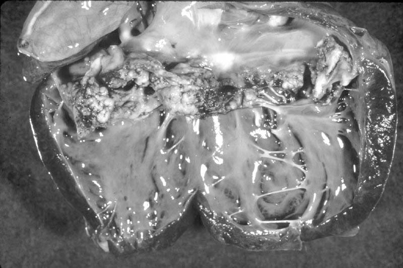 NG 79 Infektív endocarditis Lefolyása lehet: - Acut sepsis ( láz, hidegrázás, tachycardia, arthralgia, tudatzavar, vese és