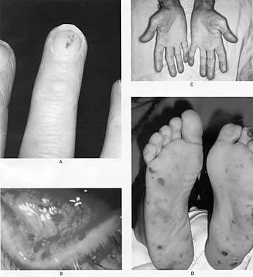 : Hemocultura (AB rezisztencia) Th: amoxicillin+ gentamycin+(rifampicin) Vancomycin (pen. allergia esetén) legalább 4-6 hétig ill.