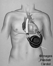 Nem gyógyszeres kezelési lehetőségek Pacemaker illetve ICD Őssejt beültetés Sebészi kezelés Szívtranszplantáció 85-90%-os egy éves túlélés 60-75%-os öt éves túlélés Cardiomyoplastica Parciális