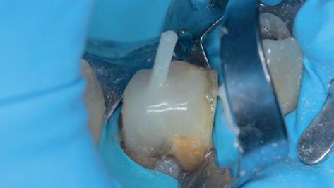 Ajánlott a 2mm-es ferrule kialakítása, azaz a csonkfelépítő anyagtól apikálisan megfelelő szélességű ép foganyag csonkkal