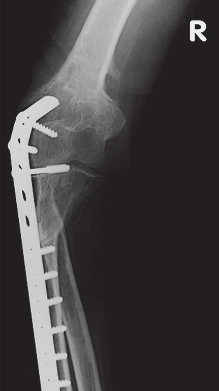 A harmadik beteg bal AP könyök-röntgenfelvétele az operációt követő kontroll során, amelyen a humerus distalis harmadán alig észlelhető egy csontnyúlvány.