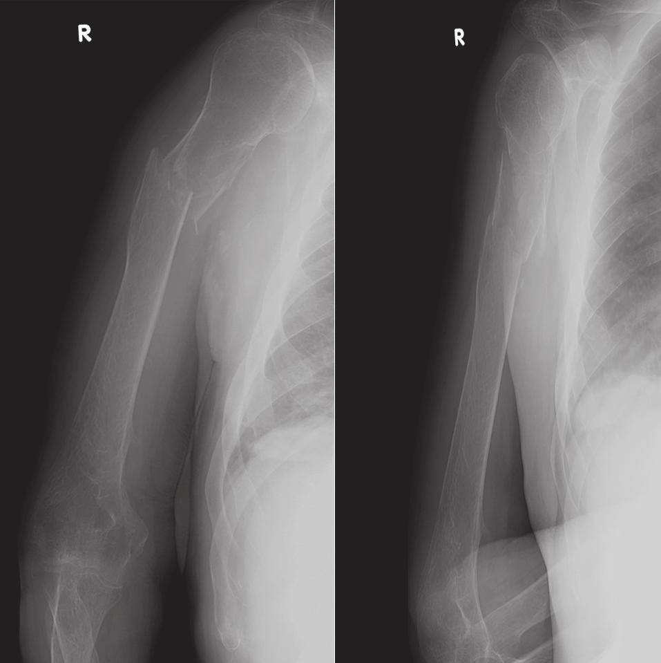 Eredménye:,,A bal humerus distalis harmadán ventralisan 7 mm-es exostosis látható. A jobb medialis condylus mellett, a lágy részben 8 mm-es meszesedés ábrázolódik.