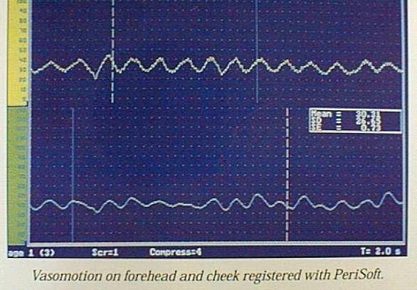 Heterogenitás normál körülmények között Lézer Doppler flowmérés Vasomotio (flowmotion)