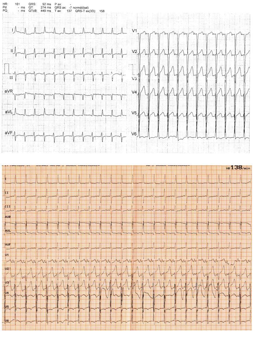 A B 1. ÁBRA. A: A 42 éves férfi betegről 2014 novemberében a helyileg illetékes Belgyógyászati Szakrendelésen készített EKG-felvétel.