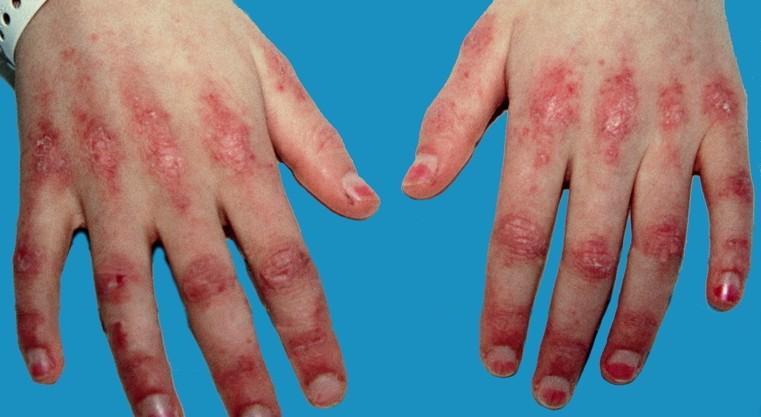 DERMATOMYOSITIS