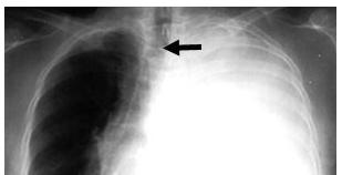 Trachea