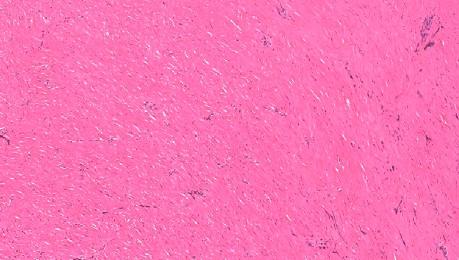 Chronic fibrosing pleuritis