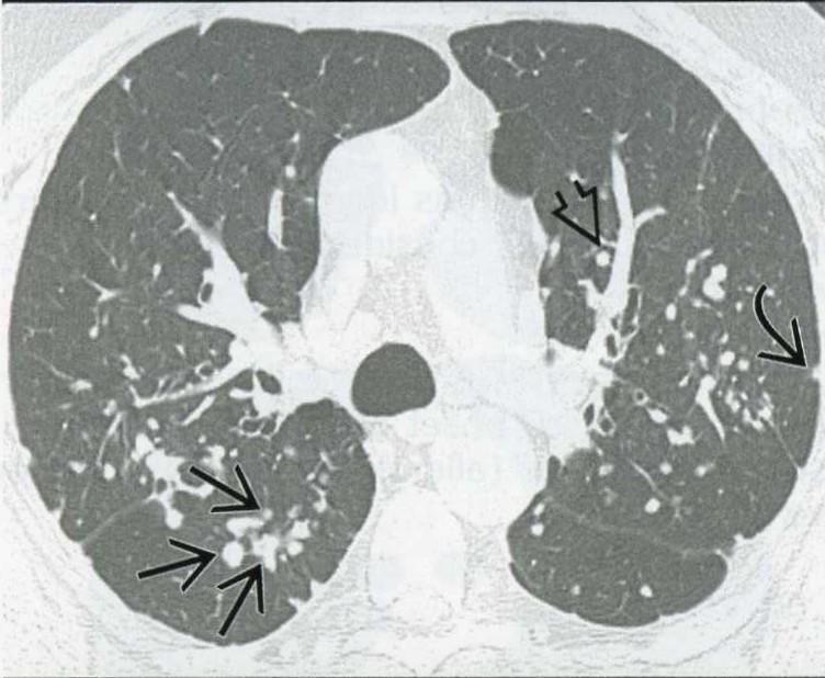 Silicosis