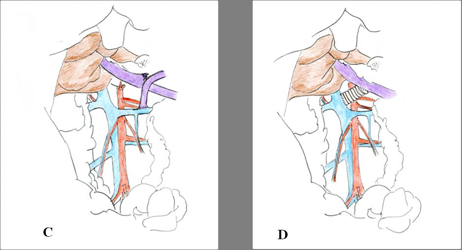 1. ábra Művi porto-cavalis anastomosis modellek patkányokban A: End-to-side porto-cavalis anastomosis, 87 B: Side-to-side porto-cavalis anastomosis, 87 C: Distalis spleno-renalis anastomosis, 68 D: H