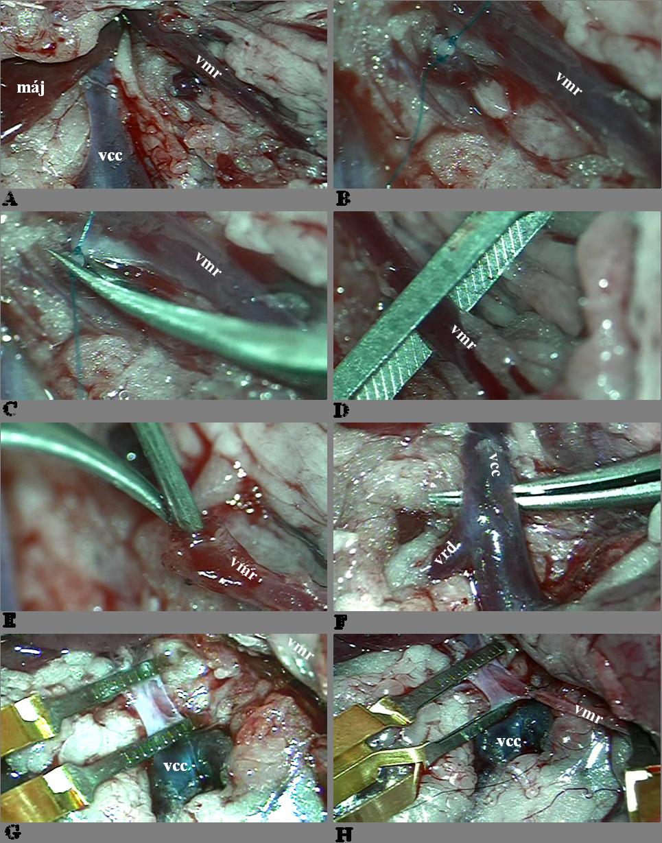 9. ábra A meso-cavalis lokalizációban kialakított end-to-side porto-cavalis shunt műtéti technikája vcc=vena cava