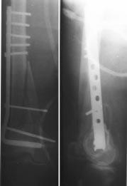 ábra). Femur distalis vég: Fektetés extenziós asztalon. Képerõsítõ alatt fedett repozíció indirekt módszerekkel. Az ízületi töréskomponens külön rögzítése fedett csavarozással javasolt (3, 4. ábra).