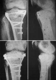 Tibia proximalis vég: Technikailag ez a legigényesebb beavatkozás. Az ízületi impressziót artroszkóposan emeljük ki. Rögzítése csavarokkal történik.