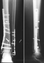 törés pontos röntgenanatómiai vizsgálata. Gyakran fedi el a fibula árnyéka a Volkmann háromszög törését. Ennek jelentõségét nem kell részleteznünk. Természetesen megoldása a fedett csavarozás.