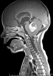 AGYTUMOR DIAGNÓZIS Képalkotó: MRI CT Kétirányú