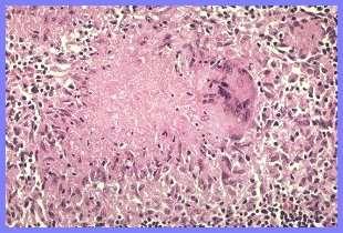 TBC Granulomatosus gyulladás Mycobacterium tuberculosis: 2-10um hosszú,