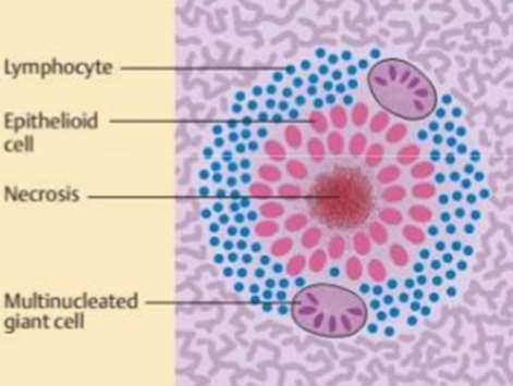 typhobacillosis: anergiás fázis, necrosis sejtes reakció nélkül Kórokozó kimutatása: