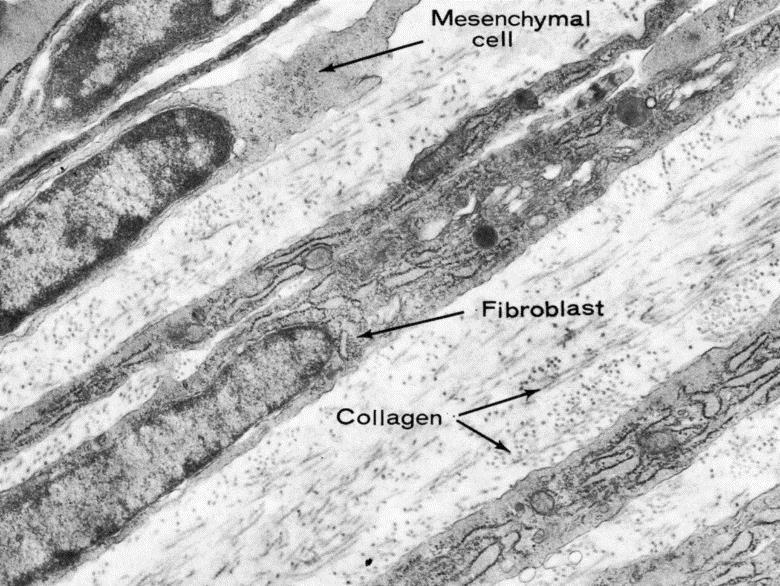 Hegképződés - Fibrózis Fibroblasztok (PDGF, FGF-2, TGF-β1, TGF-β3, EGF, TNF) - A sebbe vándorolnak és proliferálnak (stabil sejtek) - A