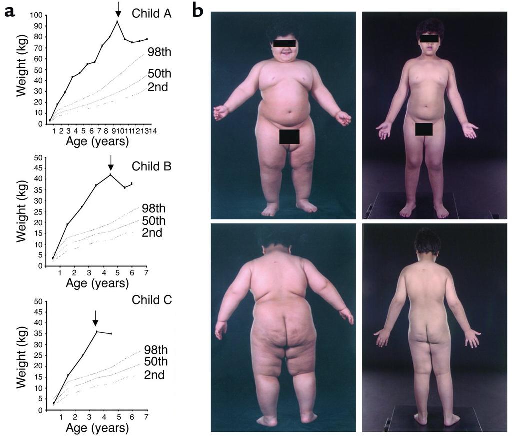 Leptin hiány előfordulása emberben Leptin