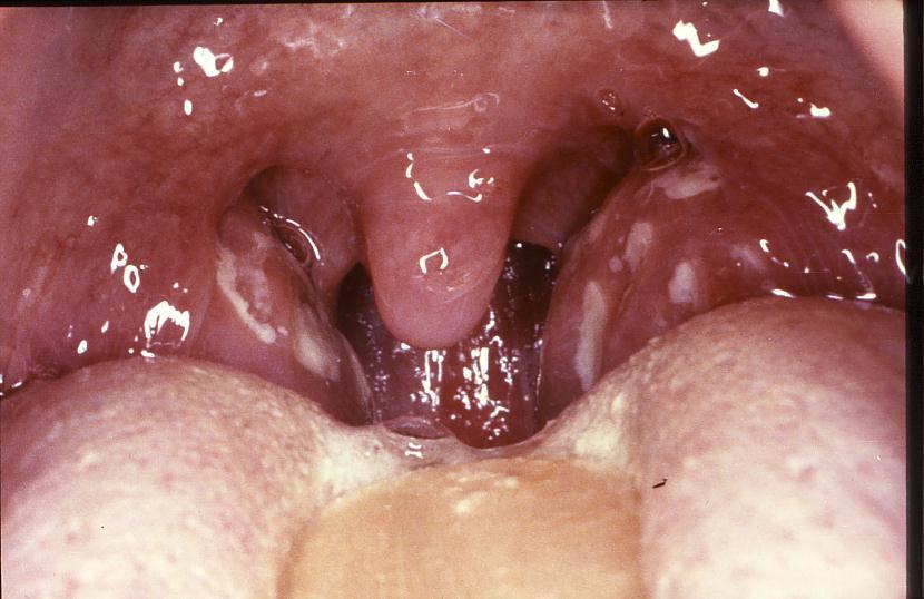 Fig. 1.29 Streptococcal tonsillitis.