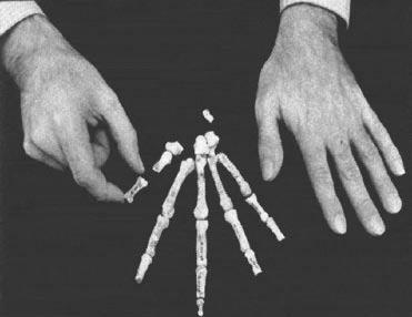 4. ábra Az Australopithecus afarensis kézcsontjai és a leletet felszínre hozó tudós (Don Johansson) keze (27). 5. ábra A: gibbon; B: csimpánz; C: emberi kéz. (27) 6. ábra Az I.