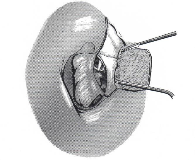 Perforatio zárása lebennyel Lehetséges anyagok: -Fascia temporalis