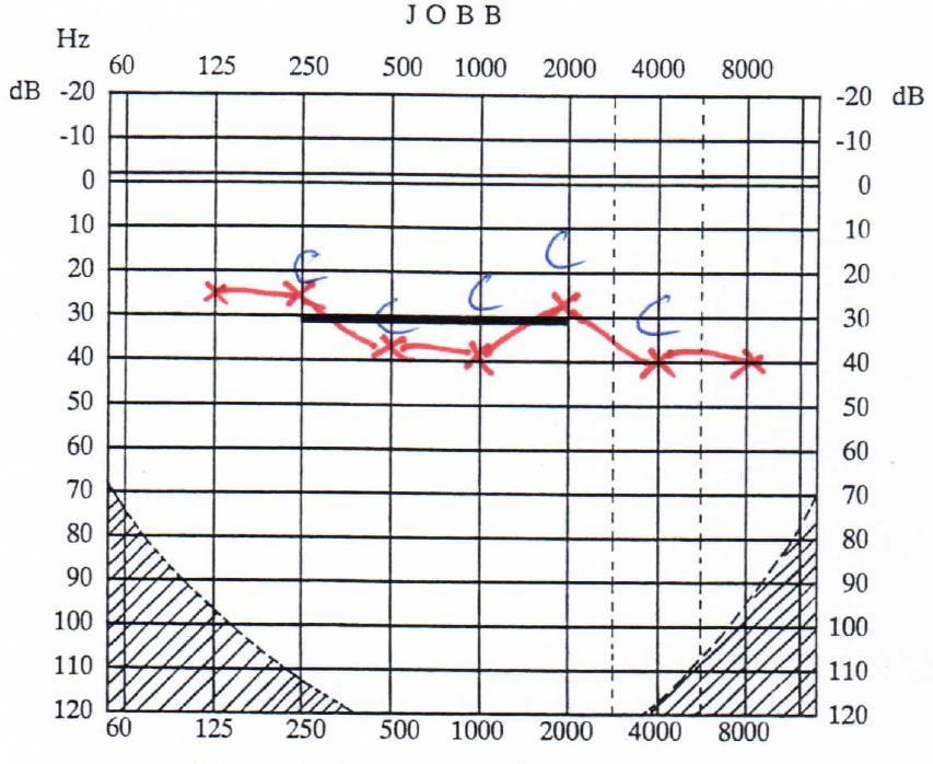 porcperichondrium compound, valamint 2,00