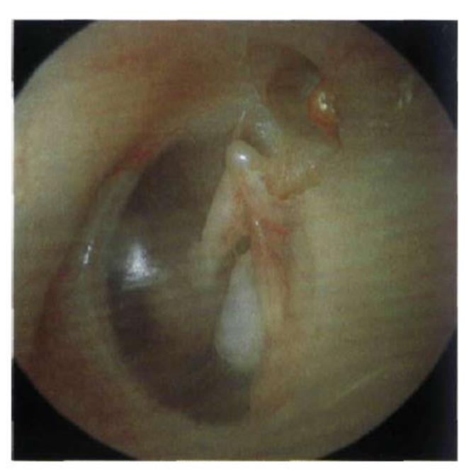 otitis media -