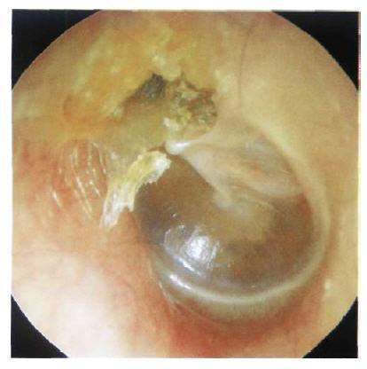 otitis media -