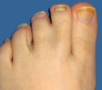 Az összenőtt lábujjak syndactylia - multifaktoriális eredetű rendellenesség.