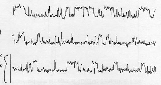 urrent Aplitude Histogra 20 pa 102 se per trae Tipikus path lap felvétel Oupany of different urrent levels during the tie period of a reording is plotted against urrent in pioaperes (10 12 Ap).