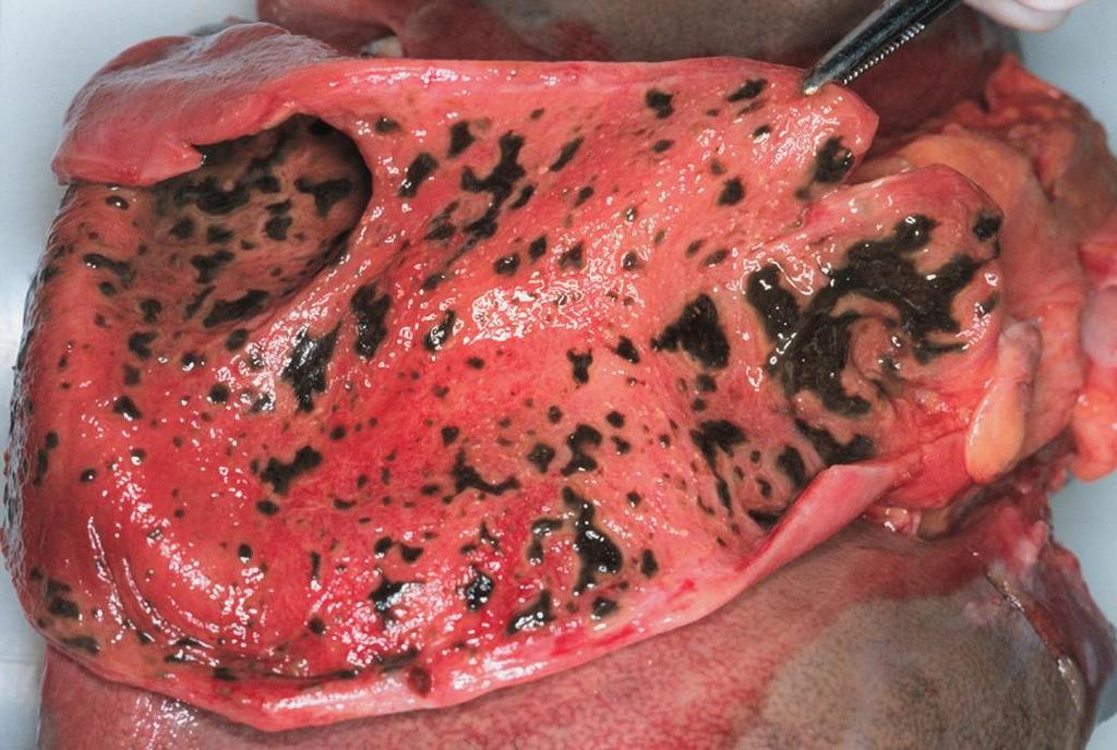 Cholecystitis acuta ulcerophlegmonosa: a nyh vérbő,