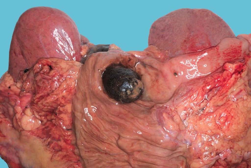 Fistula