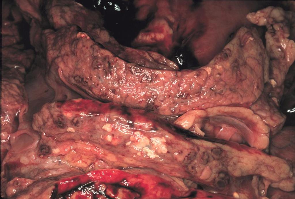 Kp. súlyos: acut necrotizáló pancreatitis - intra-