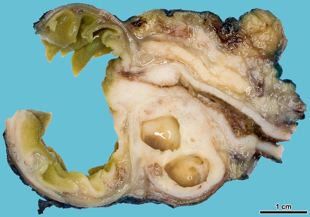 Pancreasfej carcinoma (cc), a V. papilllára és a d.