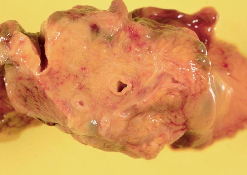Pancreas cc: tömött, élesen el nem határolódó szövetszaporulat