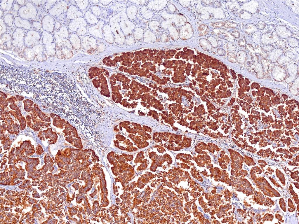 Duodenumfalban tumor,
