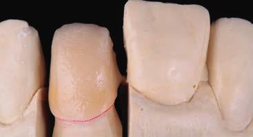 ábra: A dentin második rétegzése.