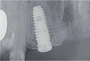 ábra) allograft (Sure-Oss, Hans-Biomed Co., Korea) készítmény volt. Membránként SMARTBuildert alkalmaztunk (3. ábra). A 4. ábrán megfigyelhető a SMARTBuilder helyfenntartó szerepe.