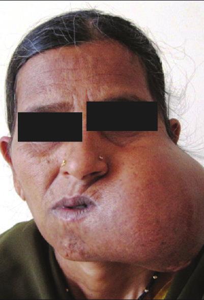 Az ameloblastoma egy fogeredetű (odontogén) daganat, amely gyakran még a kezelést követően is kiújul. Általában az alsó állkapocs hátsó részén jelenik meg.