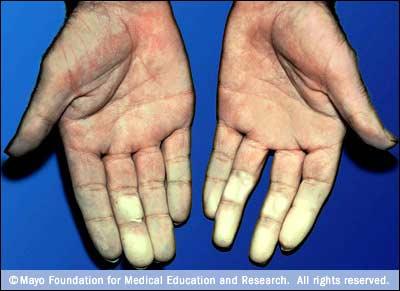 Raynaud