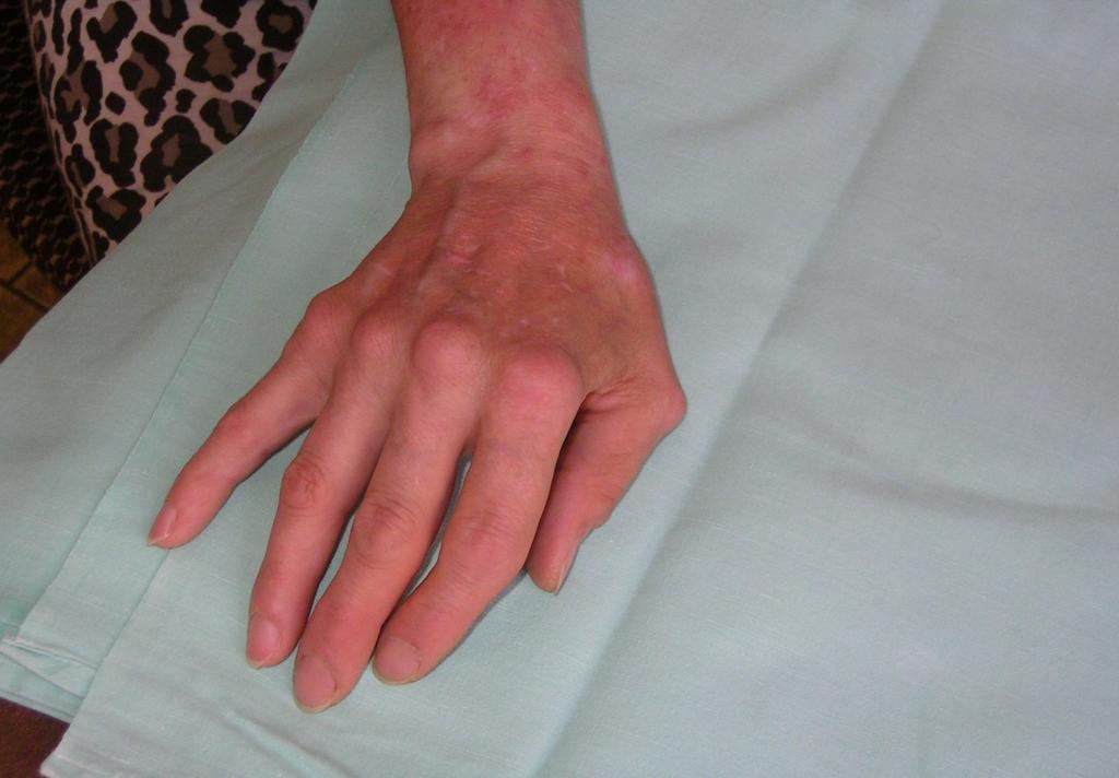 SLE arthritis