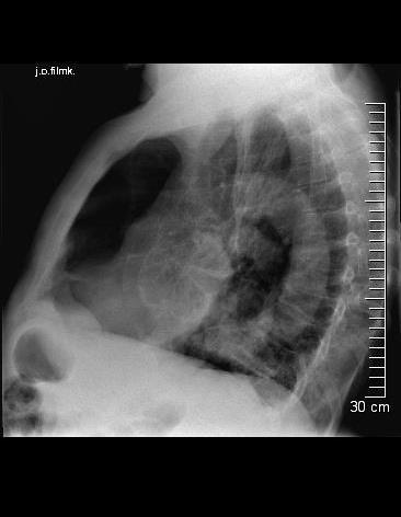 A röntgenfelvételen a jobb oldali tüdőcsúcsban 6 mm-es a lateralis mellkasfal mentén 25 mm-es, basalisan 85 mm-es köpenyszerű pneumothorax látható. (1. kép: a; b;). 1.