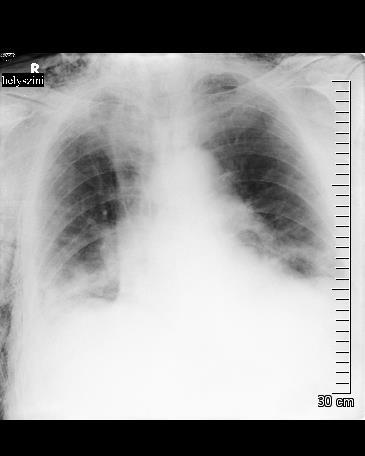 2. kép: PTX és a lateralis mellkasfal mentén 3. kép: Pneumothorax nem látható subcutan emphysema 2017.07.
