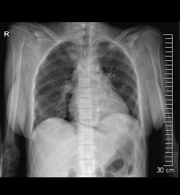 Másnap a kontroll felvételen jobb oldalt a tüdőcsúcsban 16 mm-es, laterális mellkasfal mentén 6 mm-es köpeny pneumothorax volt látható. Jobb oldalon a szívkontúr mellett kb.
