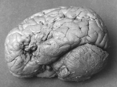) beszédstílus szószegénység teljes beszédképtelenség agrammatizmus (nyelvtan zavara) beszédértés ép Klasszikus klinikai megfigyelés: aphasia bal félteke