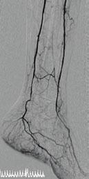 16 Az endovascularis beavatkozás, így az angioplastica is technikailag (anatómiailag és hemodinamikailag) akkor sikeres, ha a kezelt érszakasz 40%-ot meg nem haladó reziduális szűkület mellett
