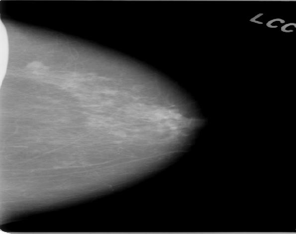 Orvosi röntgenkép-kiértékelés (mammográfia) 100