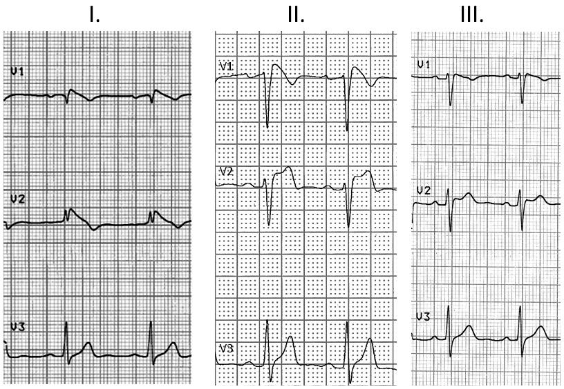 1. ábra A Brugada-szindróma három különböző EKG-megjelenési formája. Az I. típusos, klasszikus, úgynevezett coved típus, ahol nagyon valószínű a Brugada-szindróma. A II. és III.