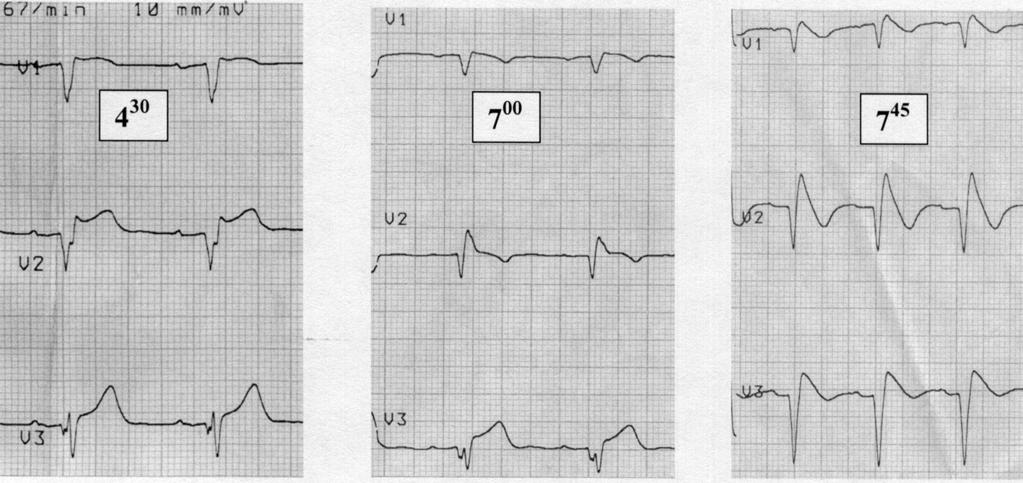 A QRS szélessége 200 ms, amit markáns coved ST-eleváció és negatív T-hullám kísér nem állapítható meg szoros összefüggés a hyperkalaemia súlyossága és az EKG-eltérések súlyossága között.