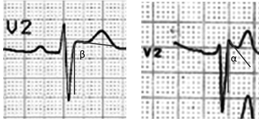 A V 1 -ben jelentkező coved ST-eleváció mellett avr-ben is van ST-eleváció és a V 5 6 elvezetésekben ST-depresszió 11. ábra Fiatal élsportoló EKG-ja korai repolarizációs zavarral.